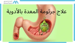 علاج الجرثومة الحلزونية بالادوية